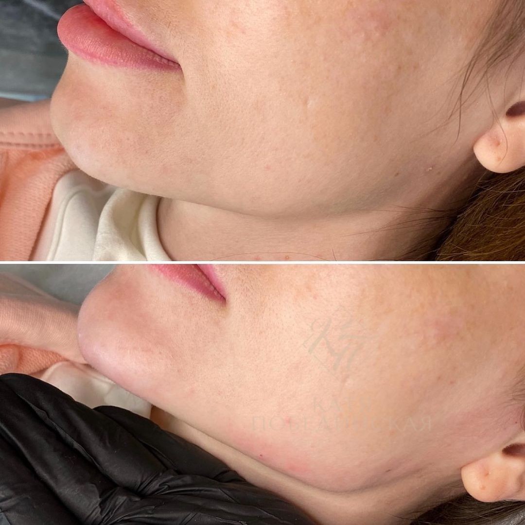 Контурна пластика кутів нижньої щелепи - Фото №4 Контурна пластика кутів нижньої щелепи - Фото №4