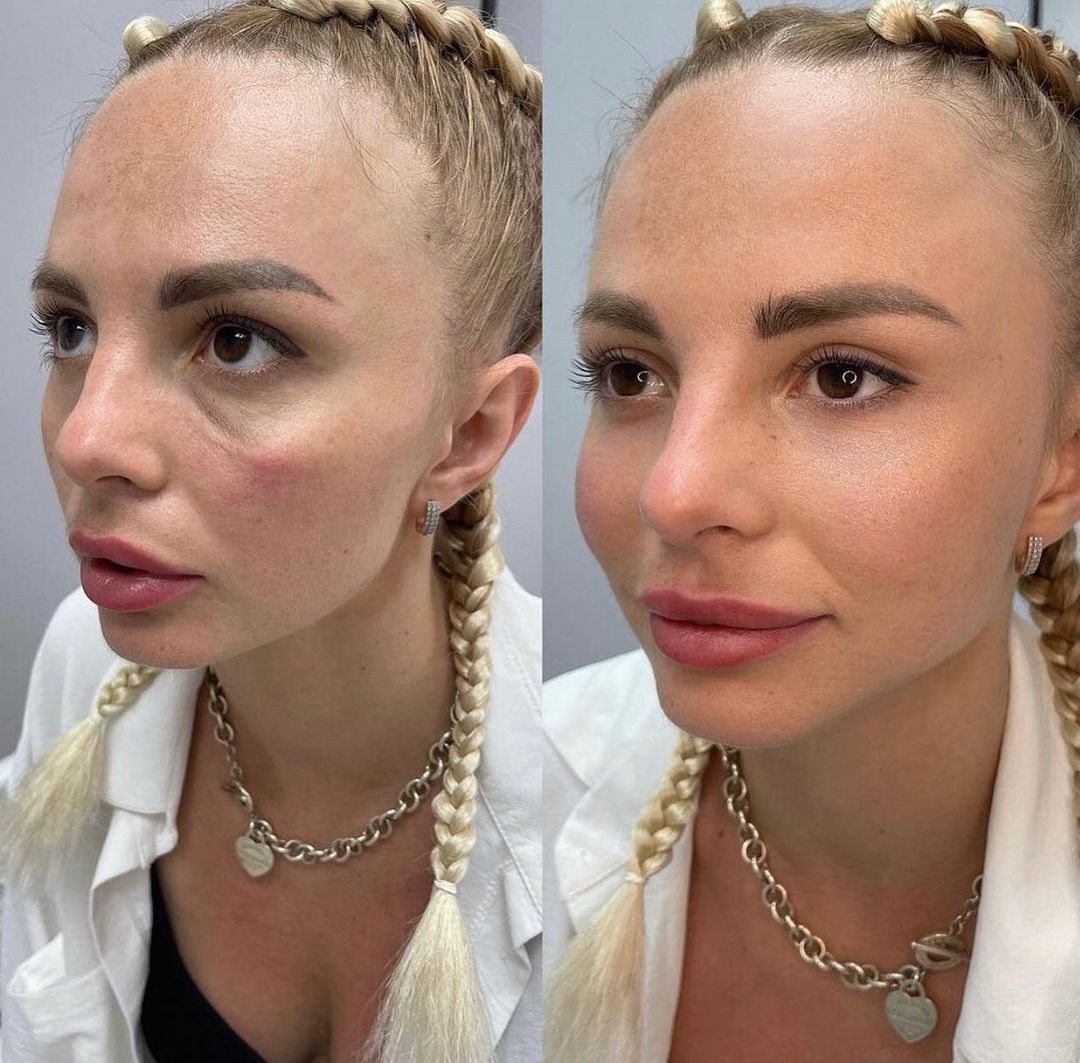 Контурная пластика Full Face - объемное моделирование лица - Фото №1 Контурная пластика Full Face - объемное моделирование лица - Фото №1