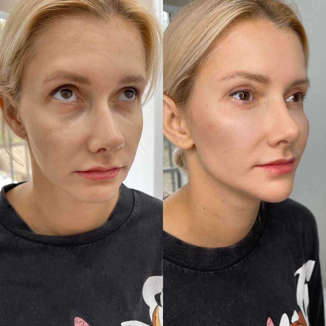 Контурная пластика Full Face - объемное моделирование лица - Фото №2 Контурная пластика Full Face - объемное моделирование лица - Фото №2